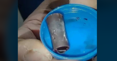 বেস্ট কলকাতা নিউজ : নজীর সৃষ্টি উত্তরবঙ্গ মেডিক্যাল কলেজ এবং হাসপাতালে, ইমার্জেন্সিতে ৫ ঘন্টার অপারেশনে বেরলো শিশুর শ্বাসনালীতে আটকে যাওয়া বাঁশি