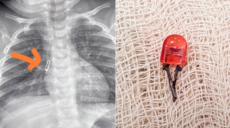 বেস্ট কলকাতা নিউজ : শ্বাসনালীতে আটকে ছিল খেলনার টুকরো, ৮ মাসের শিশুর জীবনরক্ষা হল কলকাতার সরকারি হাসপাতালে